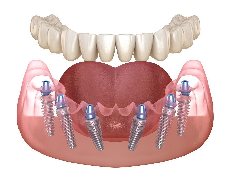 The 3 on 6 Dental Implantation Method in Turkey